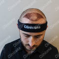 After hair transplant