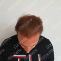 Result after hair transplant