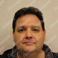 Result after hair transplant