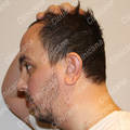 Before beard transplant