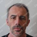 Avant la greffe de cheveux