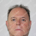 Before hair transplant