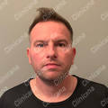 Result after hair transplant