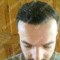Result after hair transplant