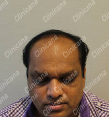 Before hair transplant Before hair transplant
