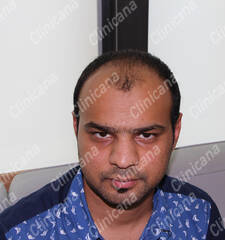 Before hair transplant Before hair transplant