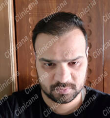 After hair transplant After hair transplant