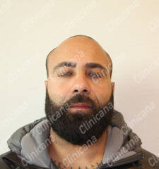 Before hair transplant Before hair transplant