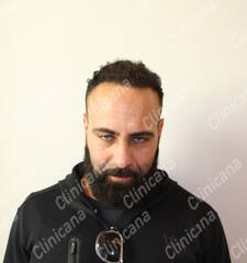 After hair transplant After hair transplant