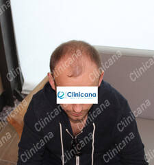 Before hair transplant Before hair transplant