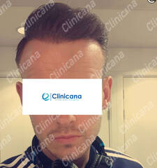 After hair transplant After hair transplant