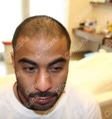 Before hair transplant Before hair transplant