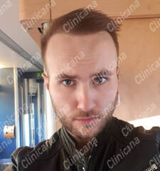 After hair transplant After hair transplant