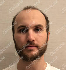 Before hair transplant Before hair transplant