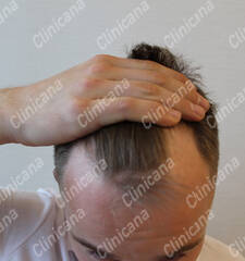 Before hair transplant Before hair transplant