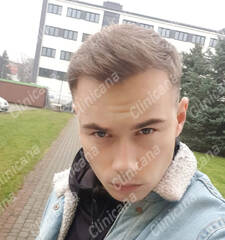After hair transplant After hair transplant