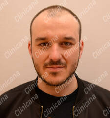 Before hair transplant Before hair transplant