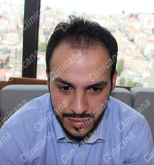 Before hair transplant Before hair transplant