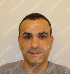 After hair transplant After hair transplant