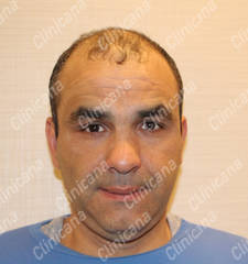 Before hair transplant Before hair transplant