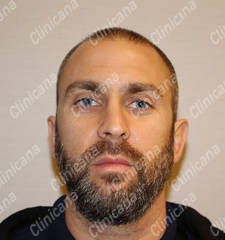 Before hair transplant Before hair transplant