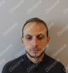 Before hair transplant Before hair transplant