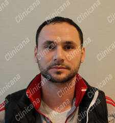 Before hair transplant Before hair transplant
