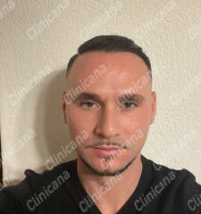 After hair transplant After hair transplant