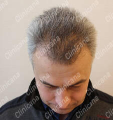 Before hair transplant Before hair transplant
