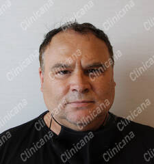 Before hair transplant Before hair transplant