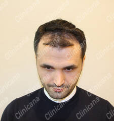 Before hair transplant Before hair transplant