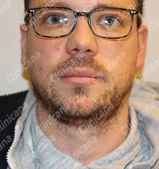Before hair transplant Before hair transplant