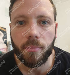 After hair transplant After hair transplant