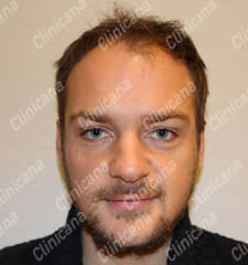 Before hair transplant Before hair transplant