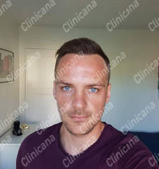 After hair transplant After hair transplant