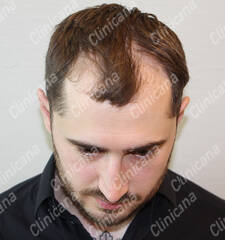 Before hair transplant Before hair transplant
