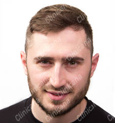After hair transplant After hair transplant