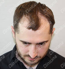 Before hair transplant Before hair transplant