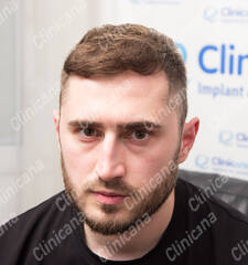 After hair transplant After hair transplant
