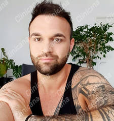 After hair transplant After hair transplant