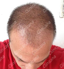 Before hair transplant Before hair transplant