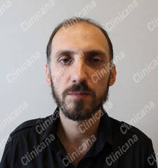 Before hair transplant Before hair transplant