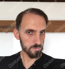 After hair transplant After hair transplant