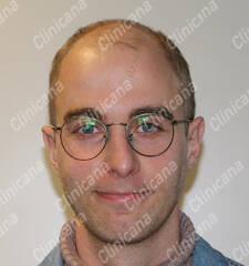Before hair transplant Before hair transplant