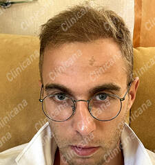 After hair transplant After hair transplant