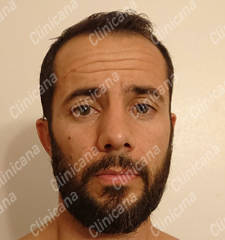 Before hair transplant Before hair transplant