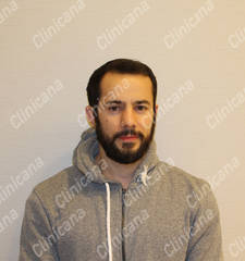 After hair transplant After hair transplant