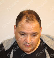 Before hair transplant Before hair transplant