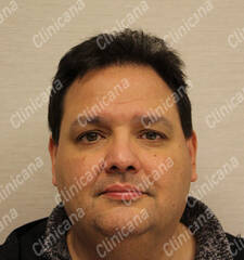After hair transplant After hair transplant
