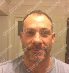 Before hair transplant Before hair transplant